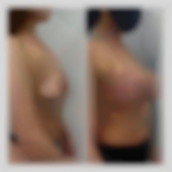 Увеличение груди от 2300€ все включено
                    Медицинский центр Аура Киев