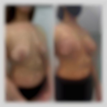 Увеличение груди от 2300€ все включено
                    Медицинский центр Аура Киев