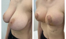 Уменьшение груди с подтяжкой 2200 € все включено Медицинский центр Аура Киев