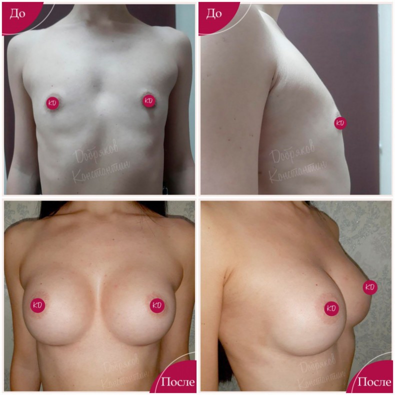 Увеличение груди импланты Polytech Replicon 315 ml. Dual pla, фото - Пластический хирург Константин Добряков