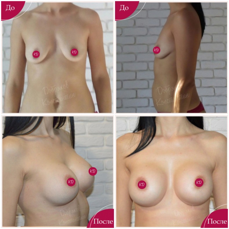 Увеличение груди с коррекцией птоза 1 степени без подтяжки P, фото - Пластический хирург Константин Добряков