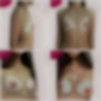 Увеличение груди импланты Motiva ergonomix 335 ml. Dual pla