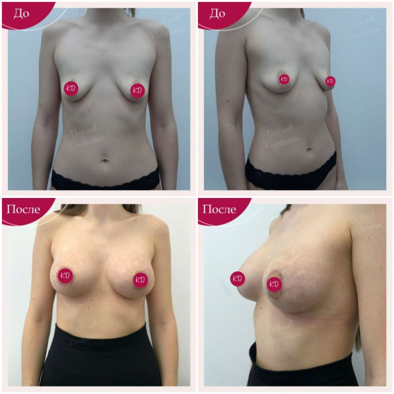 Увеличение груди, коррекция тубулярности, импланты Motiva er, фото - Пластический хирург Константин Добряков