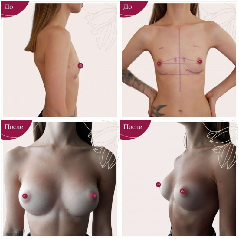 Увеличение груди импланты Polytech Replicon 240ml dual plane, фото - Пластический хирург Константин Добряков