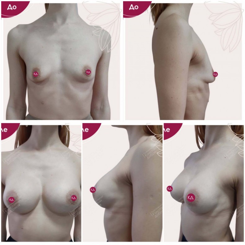 Увеличение груди, коррекция тубулярности, импланты Plytech R, фото - Пластический хирург Константин Добряков