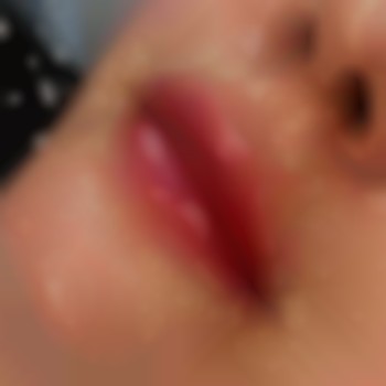 Збільшення губ