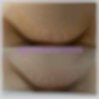 Результат зоны бикини