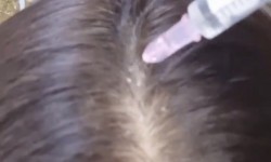 Мезотерапия волосистой части головы Косметолог Юлия Харьков