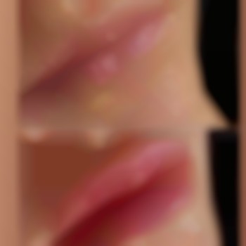 Контурная пластика губ
Легкий объём