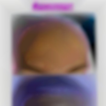 Без морщин с помощью:
Ботокс
Диспорт 
Ботулакс