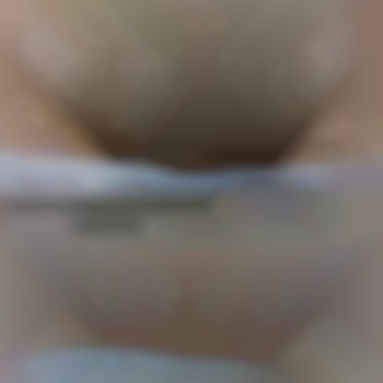 лазерная эпиляция бикини