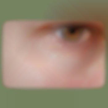 Міліуми або білі вугрі