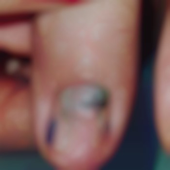 Ноготок после травмы и паронихии. Первое фото после обработ