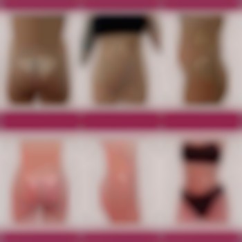 Спортивная липосакция, липофилинг ягодиц