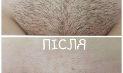 Шугаринг Мастер депиляции Альона Черкассы