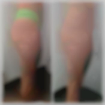 після 2-го сеансу вакуумного масажу