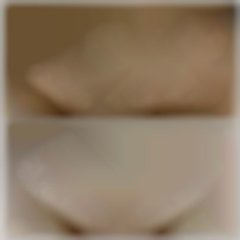 бікіні до та після першої процедури ЛЕ