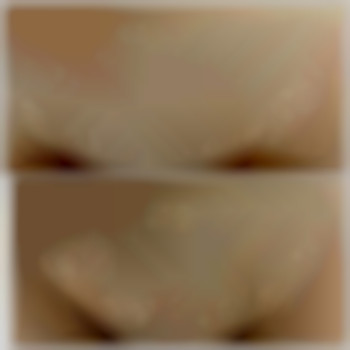 бікіні до та після першої процедури ЛЕ