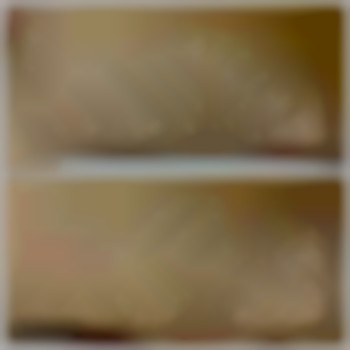 бікіні до та після першої процедури ЛЕ