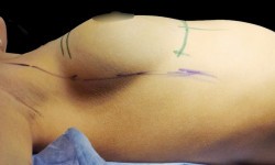 Збільшення грудей імплантами € 4 000 Клиника пластической хирургии Медицинский центр Олега Колибабы Киев