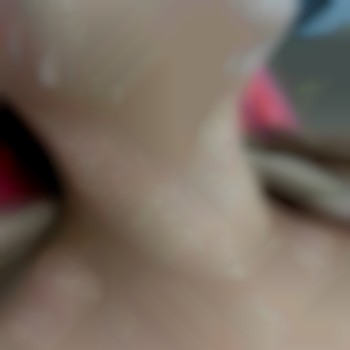 Мезотерапия. Биоревитализация