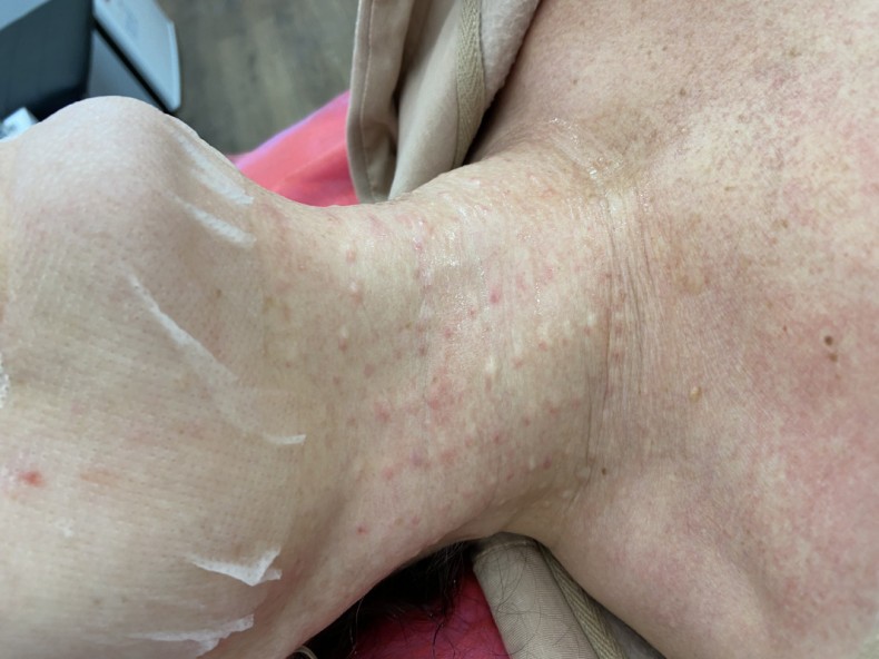 Мезотерапия. Биоревитализация, фото - Косметолог-инъекционист Елена Шулаева