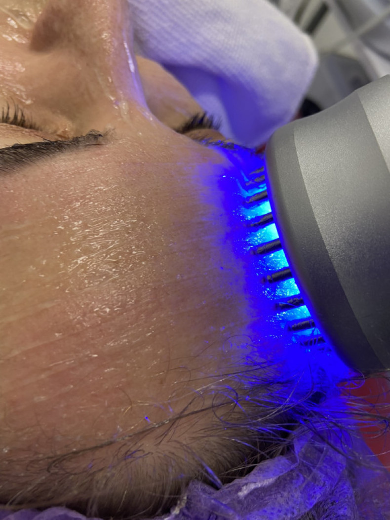 Миостимуляция и фототерапия, фото - Косметолог-инъекционист Елена Шулаева