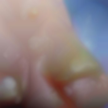 Видалення врослого нігтя з обезболенням