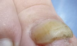 Видалення врослого нігтя Подолог Тетяна Ровно