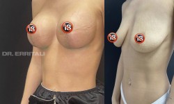 Якорная подтяжка груди Пластический хирург Абдель Харьков