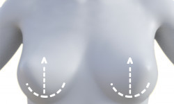 “Т” - подібна пластика молочних залоз Медицинский центр Alpha Cell Ровно