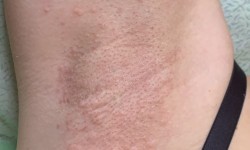 Электроэпиляция тело Мастер депиляции Ирина Харьков