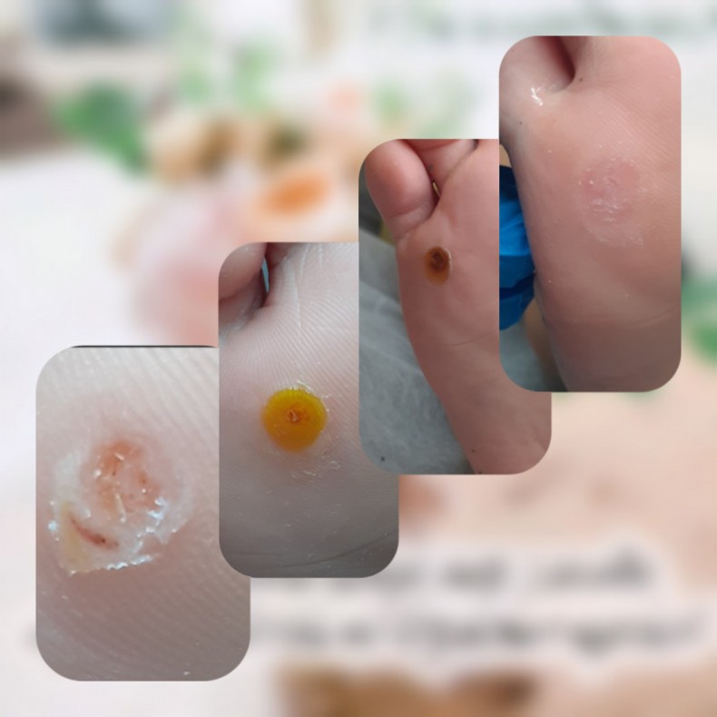 Обробка бородавки, фото - Подолог Тетяна Сметанка