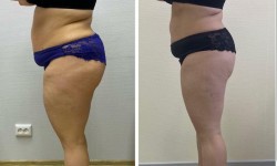 Вакумно-роликовый баночный массаж Массажист Юлия Одесса