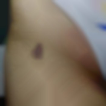 Шкіра після електроепіляції