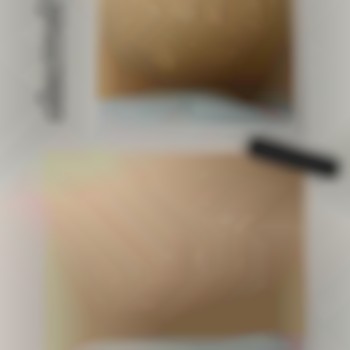 Електроепіляція бікіні.