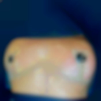 подтяжка груди