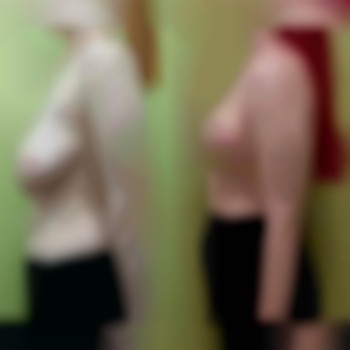 подтяжка груди