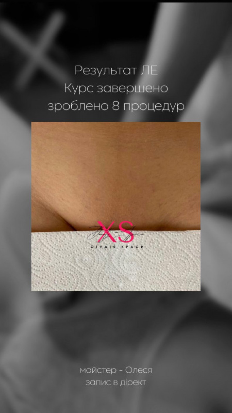 Результат після лазерної епіляції, фото - Салон красоты XS beauty studiо