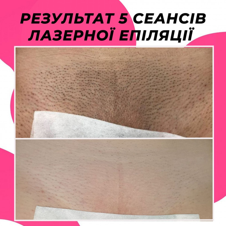 Лазерна епіляція бікіні в Києві - результат 6 сеансів  #лазернаепіляція, фото - Салон красоты Мастерская Красоты "Юлии Юдиной"