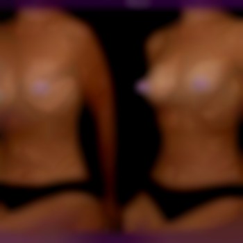  #збільшення_грудей_Запоріжжя
 #збільшення_грудей_ціна
 #збільшення_грудей_допісля