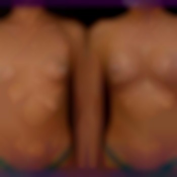  #збільшення_грудей_Запоріжжя
 #збільшення_грудей_ціна
 #збільшення_грудей_допісля