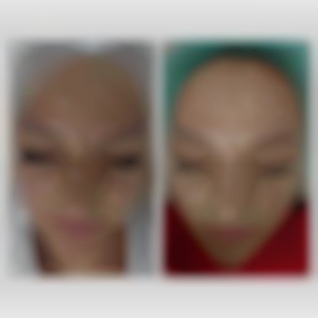 Лікування акне. Періодичні чистки обличчя + домашній догляд