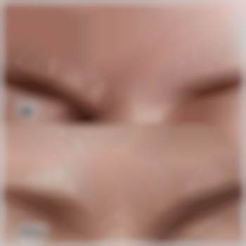 Мезотерапія міжбрівної зморшки. Курс - 5 процедур.