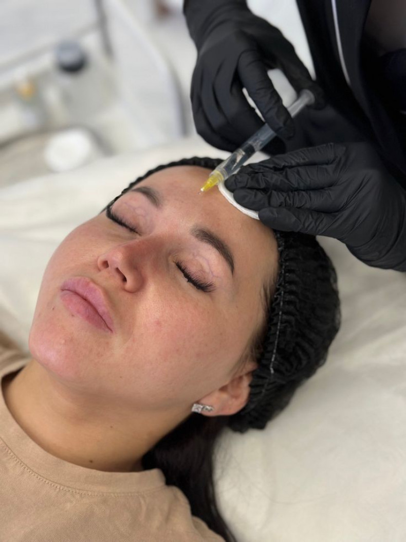 Робота з пігментацією і куперозом, фото - Врач-косметолог Наталія Морару