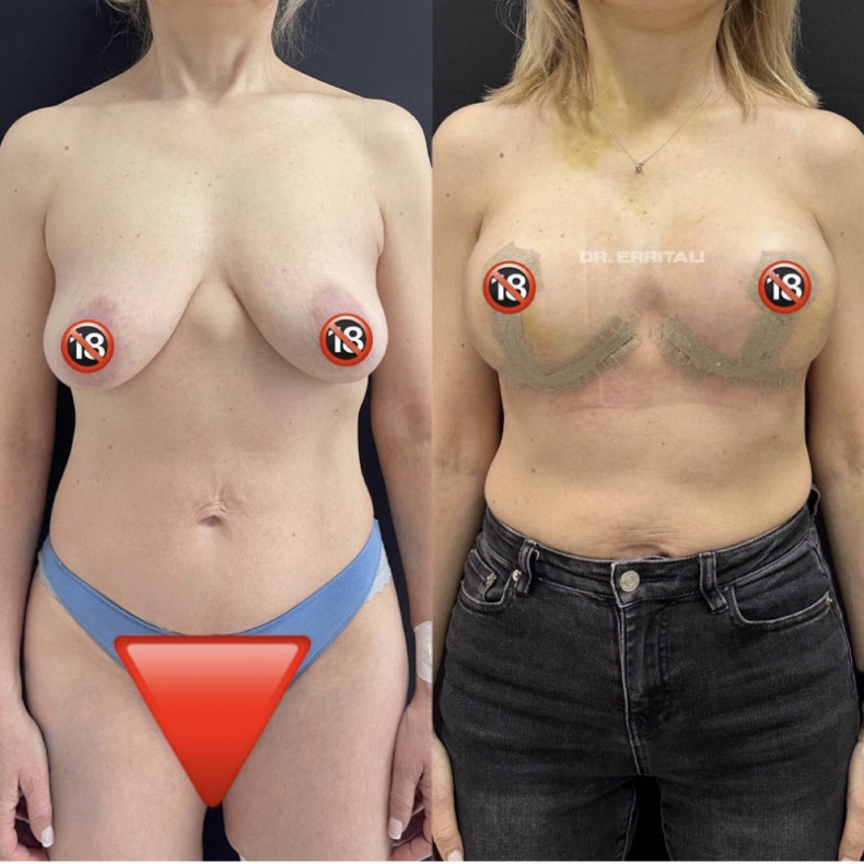 Подтяжка груди, фото - Пластический хирург Абдель Эрритали