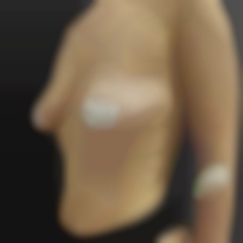 Маммопластика (увеличение груди)
                    Пластический хирург Абдель Харьков