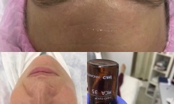 Биоревитализация Пилингами Косметолог Ирина Одесса