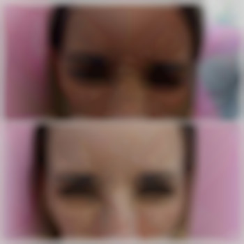 Ботокс межбровья, фото - салон красоты BeCute