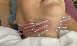 Ліфтинг шкіри нитками (Тредліфтинг) Косметолог Світлана Киев